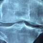 Menopausal hormone therapy reduces risk of low bone mineral density by 69%, retrospective study finds
